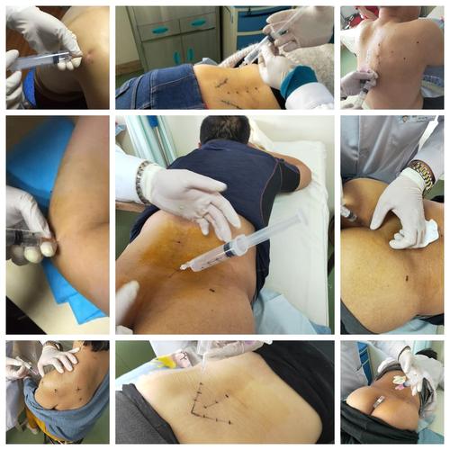 侧隐窝和骶管注射及神经阻滞治疗联合三氧局部注射治疗颈,腰,肘,肩,腿