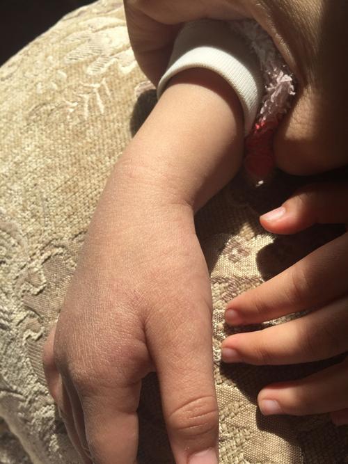 三周半宝宝沙土性皮炎一个半月了,手指蔓延到手腕,去医院开了药,手指