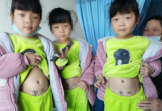 湖北蕲春县医院为3胞胎女孩实施小儿疝气微创手术