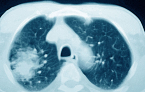 肺癌有什么症状?肺部有阴影是肺癌吗?胡群峰教授告诉你如何判断!
