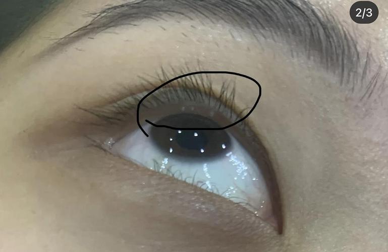 (慎入)有没有姐妹上眼皮里长过这种小疙瘩…早上.