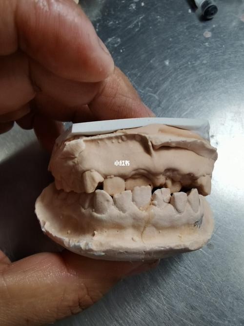 儿童反颌矫治器_支架_医疗健康_医疗器械