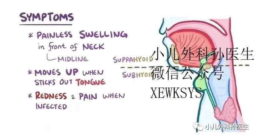 drsun小朋友长出了喉结不那可能是甲状舌管囊肿