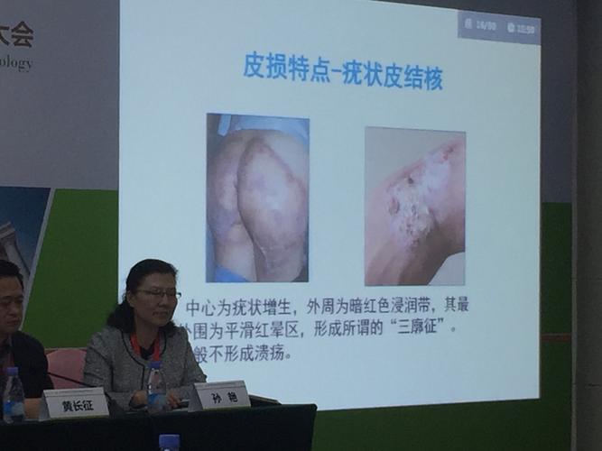 皮肤结核实验室检查