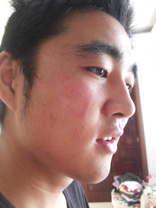 脸上长了皮肤藓,用了百消膏,和藓立克效果不理想,请各位大神帮我看看