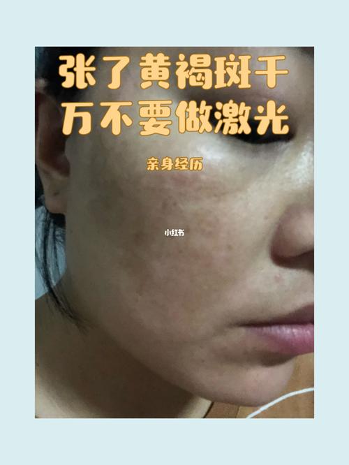 黄褐斑千万不要做激光_黄褐斑_祛斑_美妆_医美整形