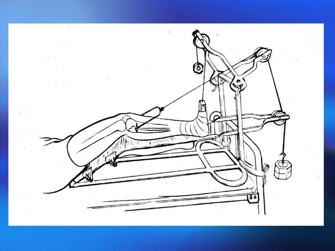 股骨干骨折 非手术治疗 手术治疗 3岁以下儿童 垂直悬吊皮肤牵引