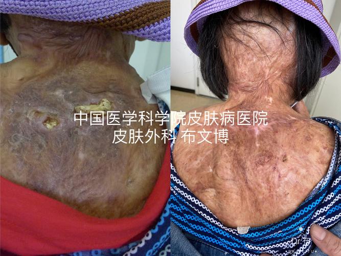 化脓性汗腺炎可以治疗,可以治愈