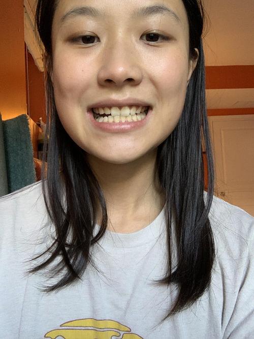 门牙对齐可以看到下颌完全歪了