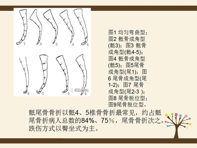 如何诊断骶尾骨骨折ppt