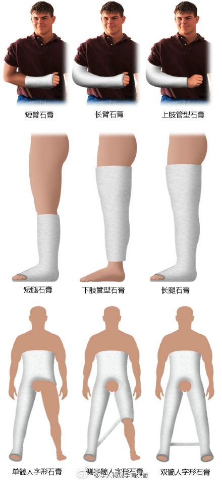 四肢常见的石膏固定方法