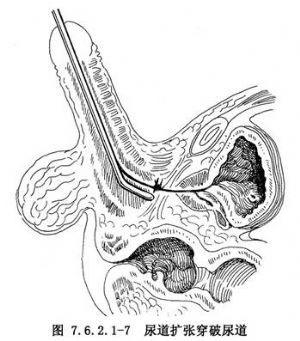 尿道出血   尿道探子通过狭窄部位,可使局部粘膜撕裂发生出血.