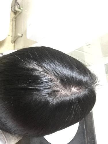 发缝到后脑勺去了怎么办