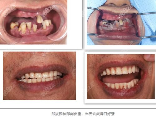 看,上海雅悦齿科刘定斌院长穿颧穿翼全口种植牙价格和