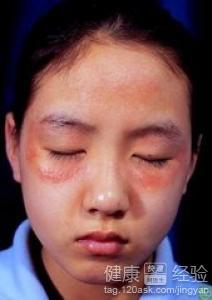 眼睑周围的神经性皮炎怎么样治疗