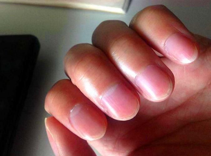 指甲表面,有明显的竖纹是怎么回事?是营养不良还是病态