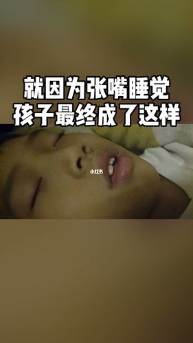 因为长期张嘴睡觉,孩子成了这样_腺样体肥大_母婴