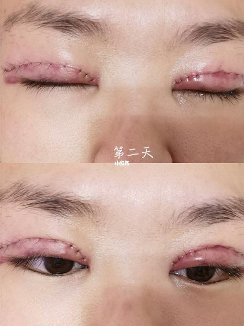 全切双眼皮去皮去脂 未开眼角_全切双眼皮_双眼皮手术