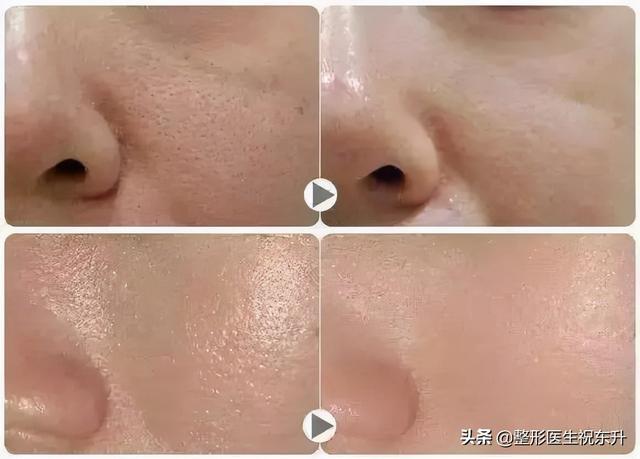 过来人总结:做水光针的5条心得