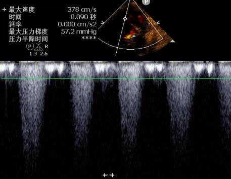 【病例分享】超声心动图诊断急性心肌梗死合并室间隔穿孔