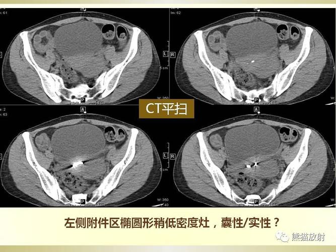 诊断思路分析丨盆腔脏器病变(ct平扫 增强)