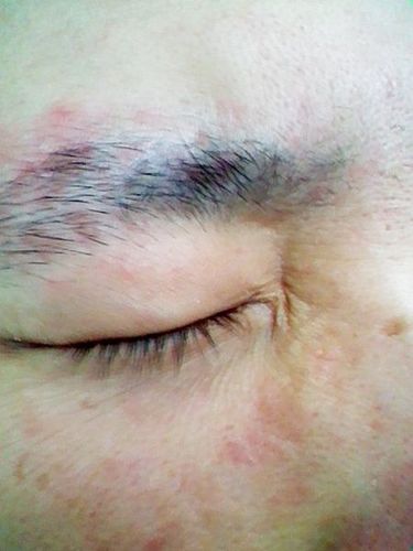 眉毛里面也有,不敢挠,一挠就变的特别红,就变肿. 看过医生,医生