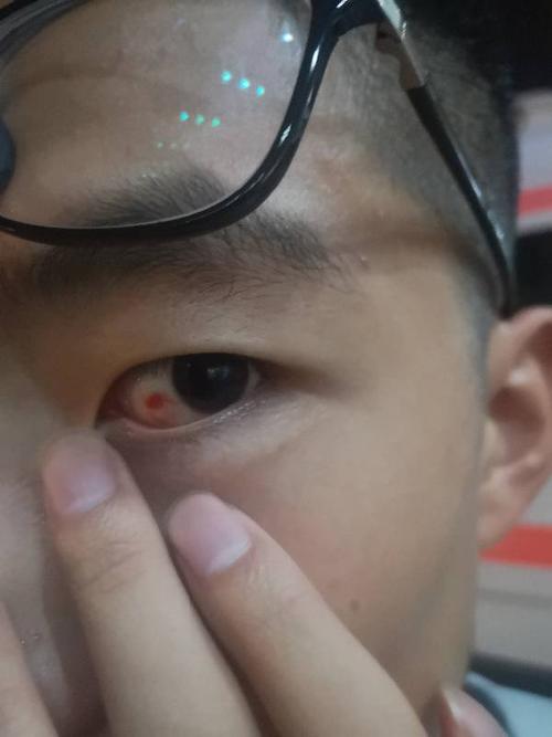眼睛被手戳了一下,晚上发现有一个血点,没什么异样