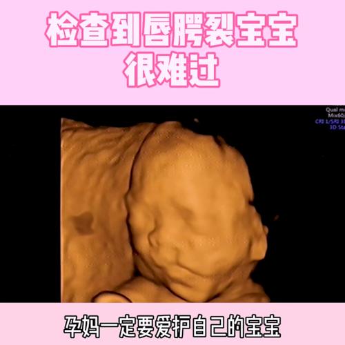 四维检查到唇腭裂的宝宝,很难过!_四维_母婴_孕产经验