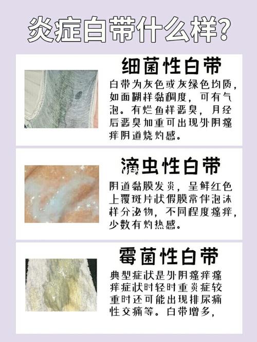 我的白带像豆腐渣一样,剑查了才知道是炎症_炎症_妇科