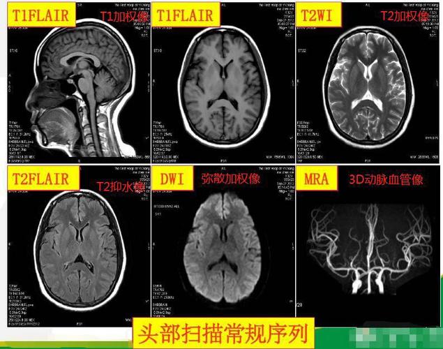 磁共振——你对它了解多少?系列科普之颅脑篇