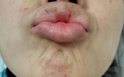 嘴唇裂开个口子怎么办啊