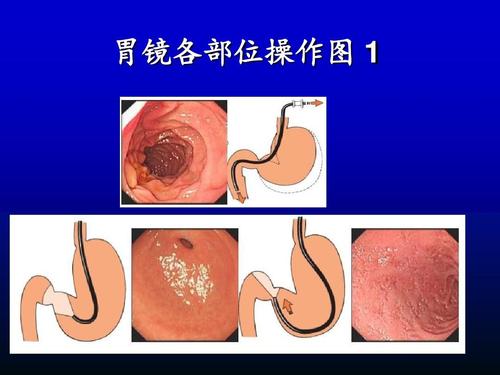 胃镜各部位操作图