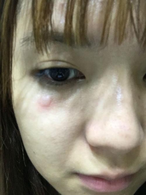 脸上颧骨位置每天都长一个小包,然后又自己消了,不痛不痒,像蚊子包.