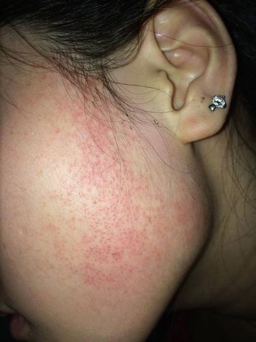 大家帮帮我吧,这是毛周角症吗 ?用什么产品可以去除呢