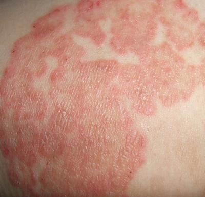 女人湿疹症状大全