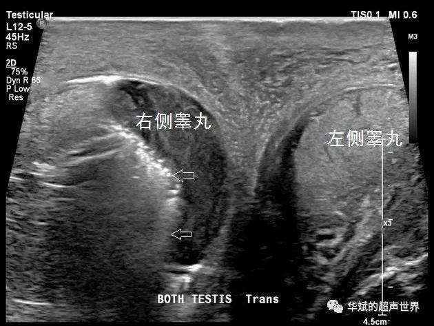 典型病例61福涅尔坏疽与气肿性睾丸附睾炎的鉴别坏死性筋膜炎气肿性