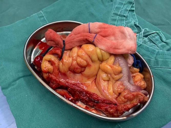 79岁高龄患者乙状结肠癌根治手术成功实施