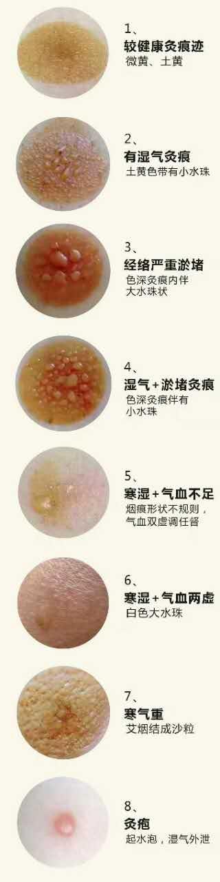 你的健康你做主～艾灸原来这么简单!