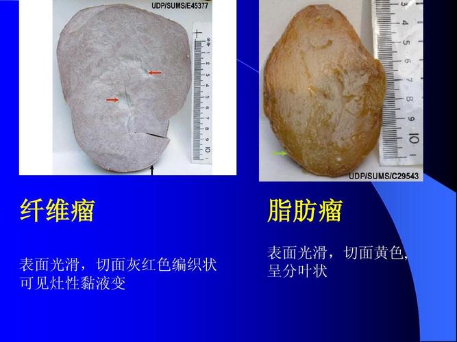 纤维瘤 表面光滑,切面灰红色编织状 可见灶性黏液变 脂肪瘤 表面光滑