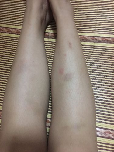 最近一个月小腿上无缘无故有淤青,好了又有,也没有磕碰过,按一下疼