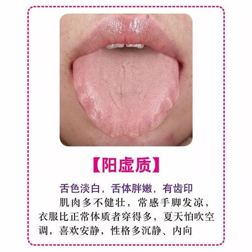 看看舌头,即可分辨出8种体质:气虚质,阳虚质,阴虚质,痰湿质,湿热质