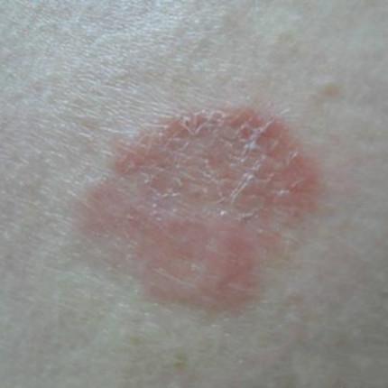 简单两个方法,让你摆脱春癣困扰