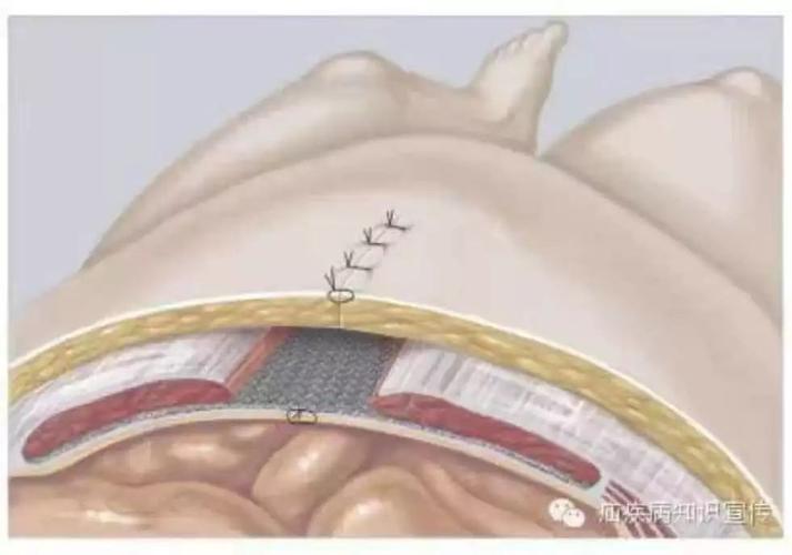 sublay法 名词解释 1,腹壁切口疝: 腹部术后,腹壁肌腱膜层愈合不良