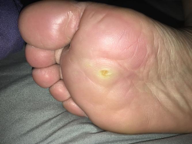 通过治疗 感觉没有一点好转 还变多了 现在已经起老茧了怎么办