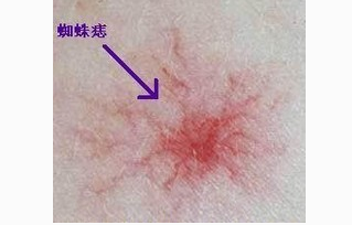 肝硬化蜘蛛痣产生原因有哪些