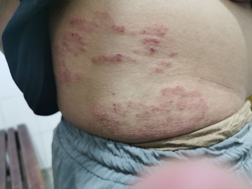 带状疱疹又名    蛇丹疮或缠腰蛇.