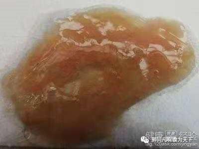 5 果酱样痰:肺吸虫病的典型表现之一.