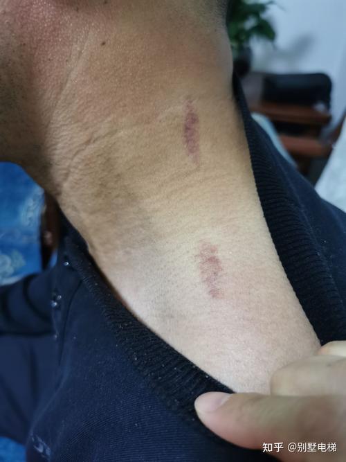 谁知道这是不是吻痕呢