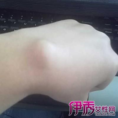 最常见的是手腕部和足背部的腱鞘囊肿.