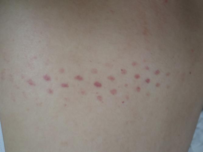后背长很规则的红点是什么原因,不痛不痒,没突起